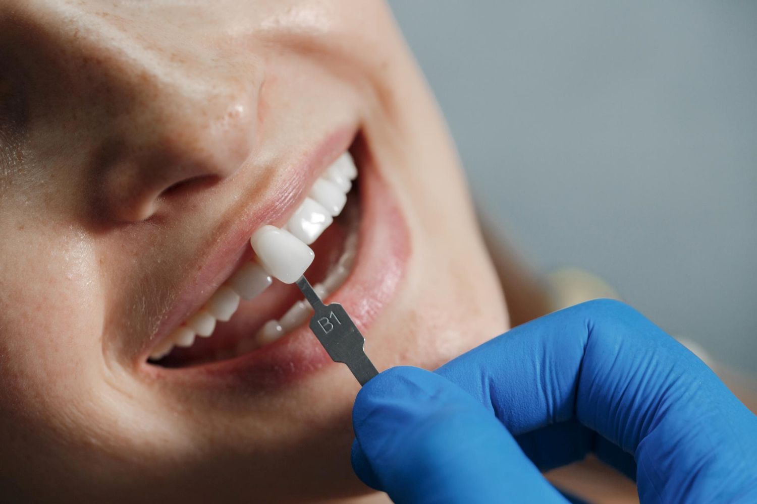 Wysoko estetyczna korona zakładana na ząb u dentysty