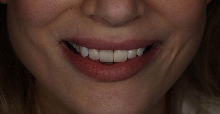 Naturalny bonding zębów wykonany u kobiety