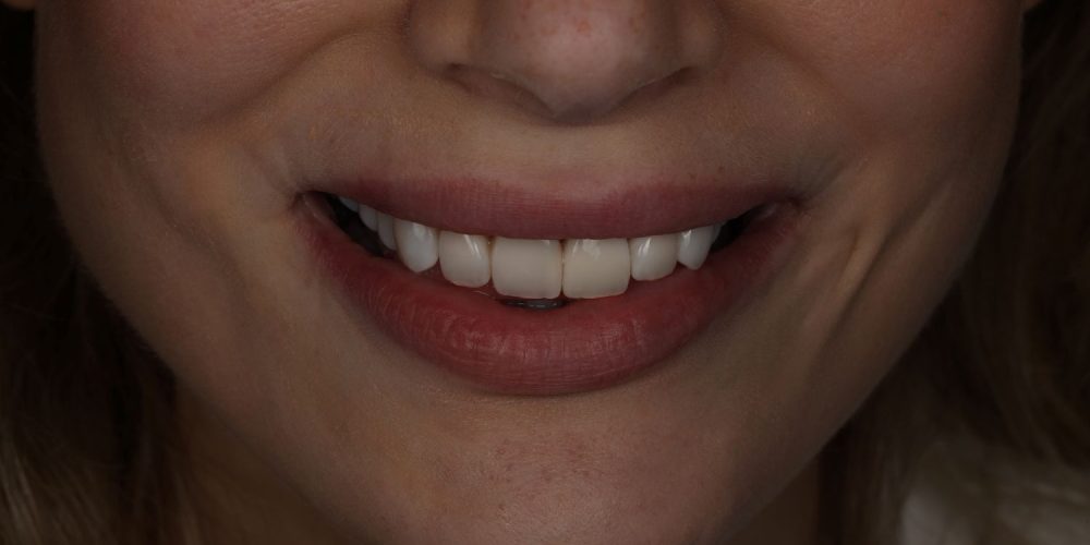 Naturalny bonding zębów wykonany u kobiety