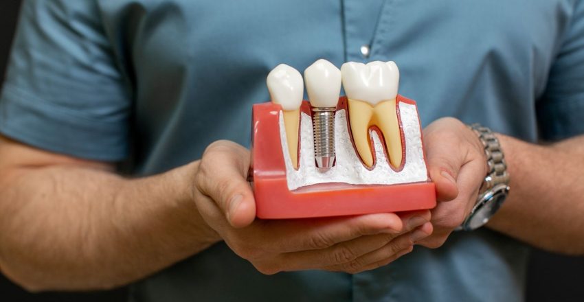 co-zamiast-implantu co-zamiast-implantu