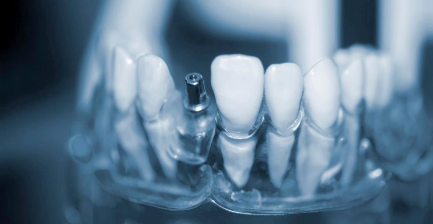 Wszczepienie implantu zębowego w gabinecie stomatologicznym