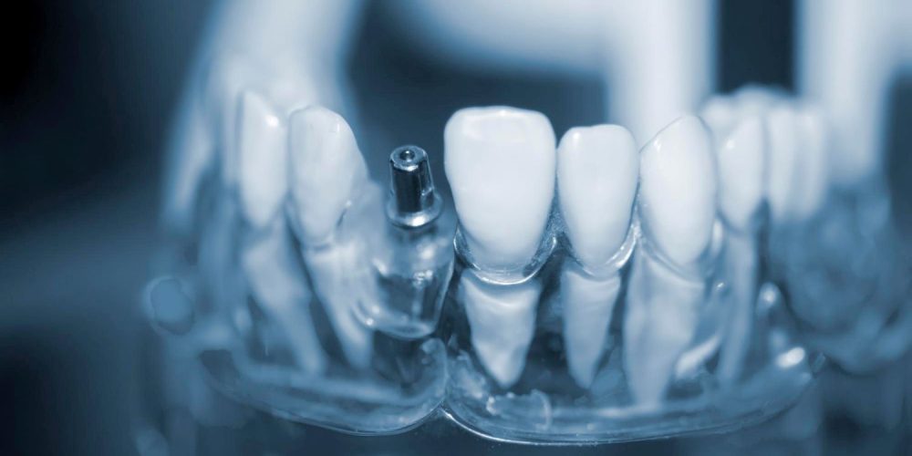 Wszczepienie implantu zębowego w gabinecie stomatologicznym